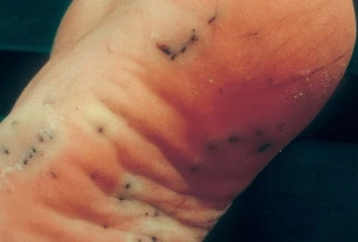 Της παραλίας τα δυσάρεστα – Τι να κάνετε αν πατήσετε αχινό, δράκαινα, τενεκεδάκι, γυαλί